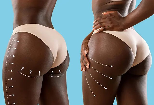 Butt Lift Sculpting